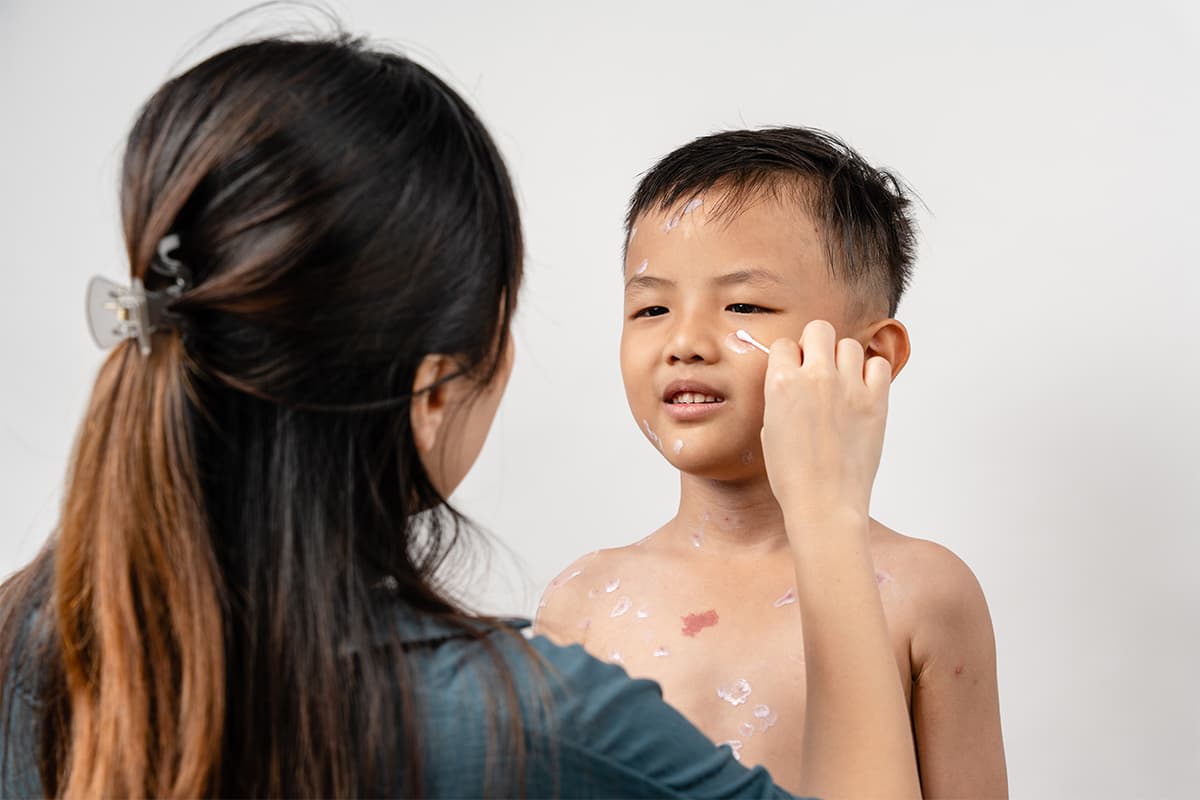 Kids with Chickenpox - Its a plus